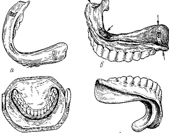 Пластиночный протез этапы. Перебазировка базиса протеза. Перебазировка съемных пластиночных протезов. Фрезерованный Базис протеза. Границы базиса съемного пластиночного протеза.