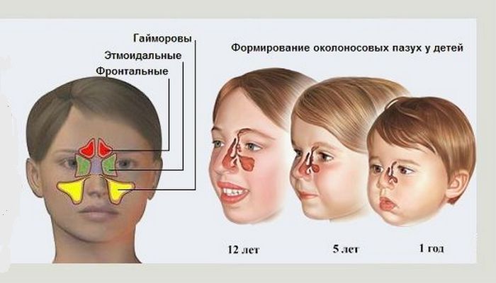 Гиперплазия слизистой верхнечелюстной. Строение носа у ребенка 2 года и пазух. Придаточные пазухи носа у детей. Особенности развития околоносовых пазух у детей. Гайморова пазуха аденоиды носа.
