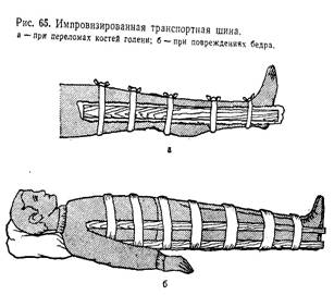 Транспортная иммобилизация при переломе костей голени. Иммобилизация при переломе пяточной кости. Иммобилизация складной шиной при переломе костей голени. При переломе костей голени производят иммобилизацию. Вакуумная шина при переломе бедра.