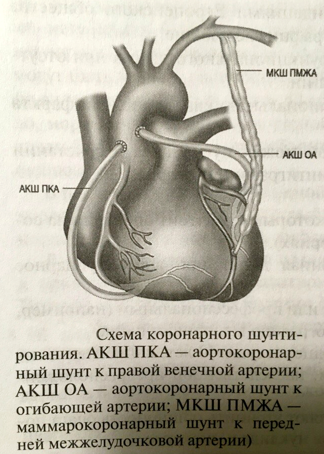 Презентация коронарное шунтирование