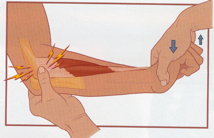 Болит рука при сгибании. Тест Томпсона эпикондилит.