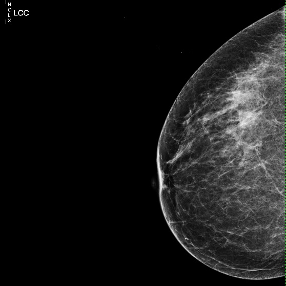 Маммография фкм. Кистозная мастопатия маммография. Фиброаденома молочной железы маммография. Узловая мастопатия маммограмма. Маммография фиброаденома рентген.