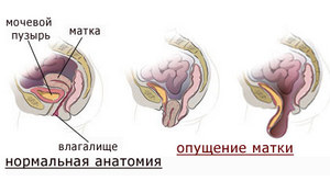 Опущение матки