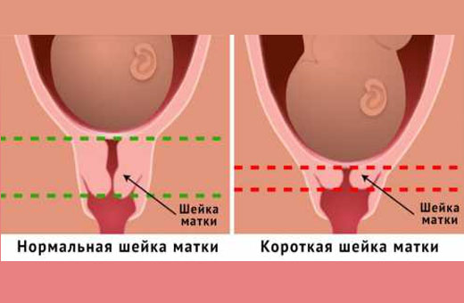 шейка матки нормальная и короткая