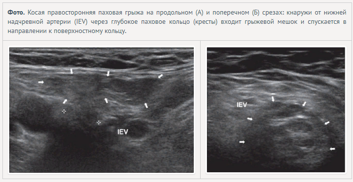 Паховая грыжа на узи фото