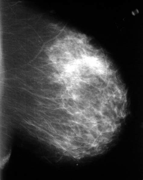 Маммография в московском. Билатеральная маммография. Фиброзно-кистозная мастопатия маммография. Мастопатия на маммографии. Папмломокератоз маммография.