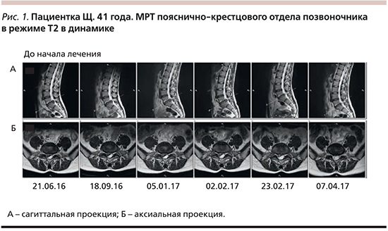 Пояснично крестцовый отдел позвоночника мрт. Мрт поясничного отдела норма. Норма мрт пояснично крестцового отдела. Мрт поясничного отдела позвоночника норма. Снимки мрт пояснично-крестцового отдела в норме.