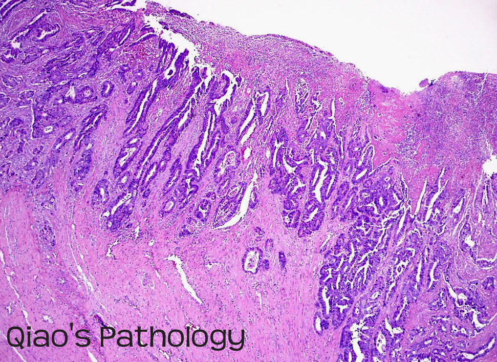 Аденокарцинома толстой. Аденокарцинома толстой кишки гистология. Аденокарцинома гистология. Аденокарцинома кишечника микропрепарат. Муцинозная аденокарцинома желудка.