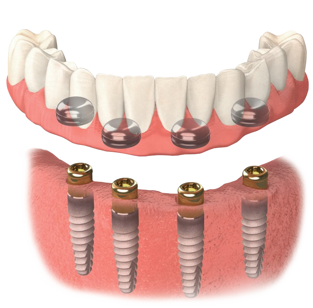 Протезирование зубов виды. Внутрислизистые зубные имплантаты. Протез на 2 имплантах на нижнюю челюсть. Несъемный мостовидный протез с опорой на 4 имплантата. Съемный протез с опорой на 4 имплантата.