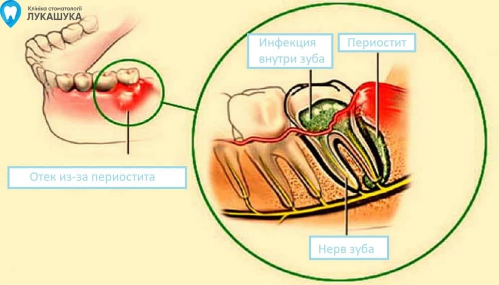 Воспаление Надкостницы Зуба Фото