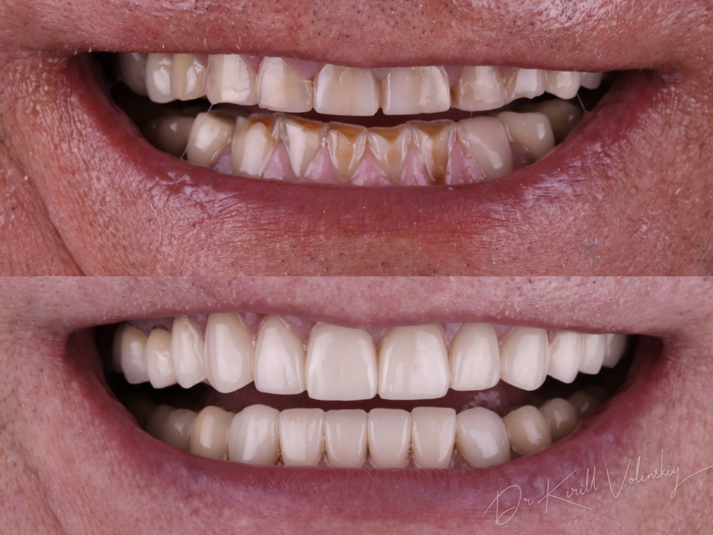 Зубы перед установкой виниров фото