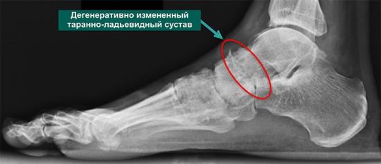 Остеоартроз стопы