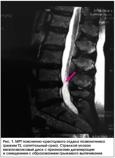 Мрт крестцово поясничного отдела позвоночника фото