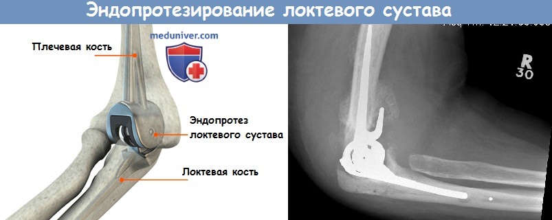 Суставы адрес. Эндопротез локтевого сустава DEPUY. Эндопротез локтевого сустава рентген. Строение эндопротеза локтевого сустава. Нестабильность эндопротеза локтевого сустава.