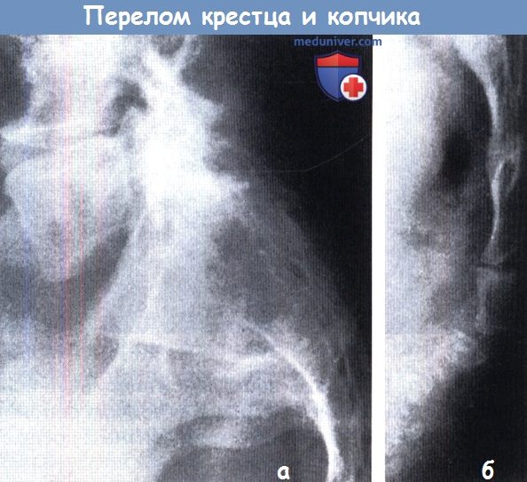 Перелом копчика