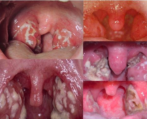 White Spots on Tonsils