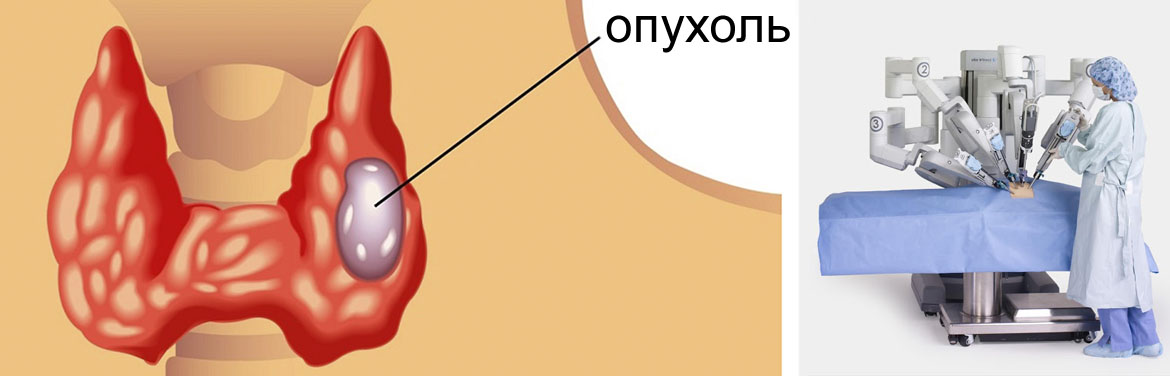 Киста щитовидной железы. Микрокиста щитовидной железы. Фолликулярная киста щитовидки. Киста в щитовидной железе симптомы.