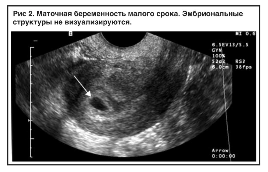 Матка на ранних сроках. Остатки плодного яйца УЗИ. Маточная беременность раннего срока. Остатки плодного яйца в матке на УЗИ. #УЗИ после медикаментозного.