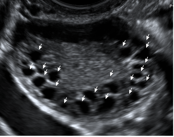 Эхо картина мультифолликулярных яичников
