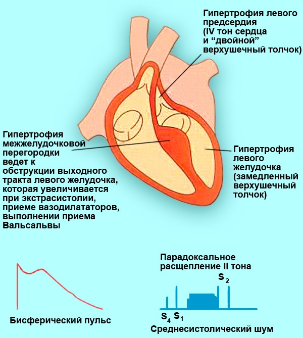 Градиент между желудочками. Гипертрофия миокарда базального отдела межжелудочковой перегородки. Асимметричная гипертрофия межжелудочковой перегородки. Анатомия межжелудочковой перегородки. Межжелудочковая перегородка на ЭКГ.