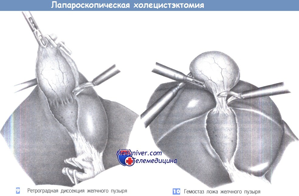 Желчный после операции. Холецистэктомия треугольник Кало. Желчный пузырь анатомия холецистэктомия. Техника операции лапароскопической холецистэктомии:. Ретроградная диссекция желчного пузыря.