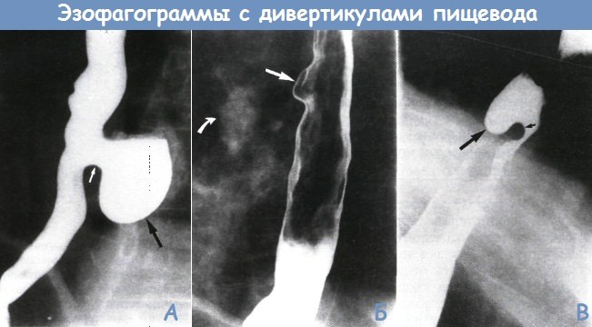 Диагностика дивертикула пищевода