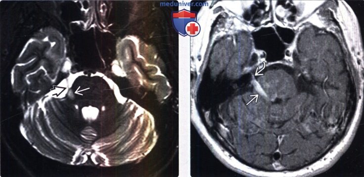 Нейроваскулярный конфликт лицевого нерва. Нейроваскулярный конфликт тройничного нерва мрт. Невралгия тройничного нерва нейроваскулярный конфликт мрт. Кт неврит тройничного нерва. Вазоневральный конфликт тройничного нерва мрт.