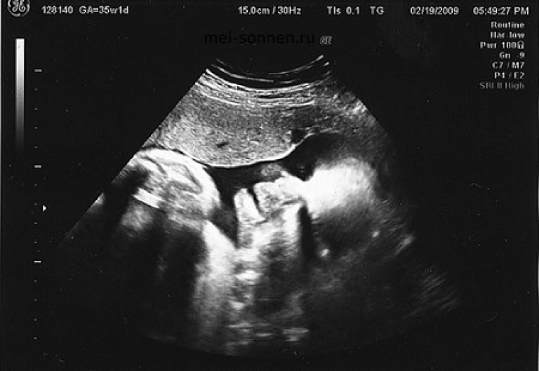 34 недели беременности фото. УЗИ снимок ребенка на 34 неделе беременности. УЗИ ребенка на 35 неделе беременности. УЗИ плода на 35 неделе беременности. УЗИ малыша на 35 неделе беременности.