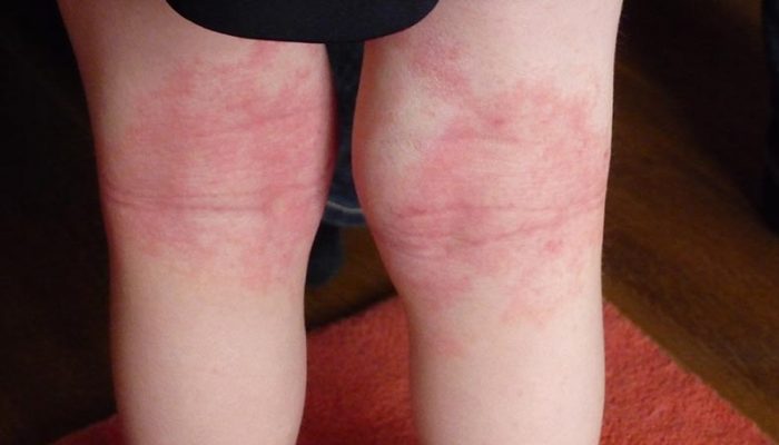 Почему возникла сыпь под коленками у ребенка или взрослого? Самые частые причины