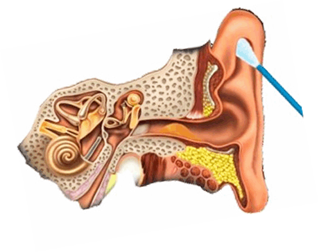 Почему образуется сера. Анатомия уха серная пробка. Строение уха серная пробка. Чёрная ушная серная пробка.