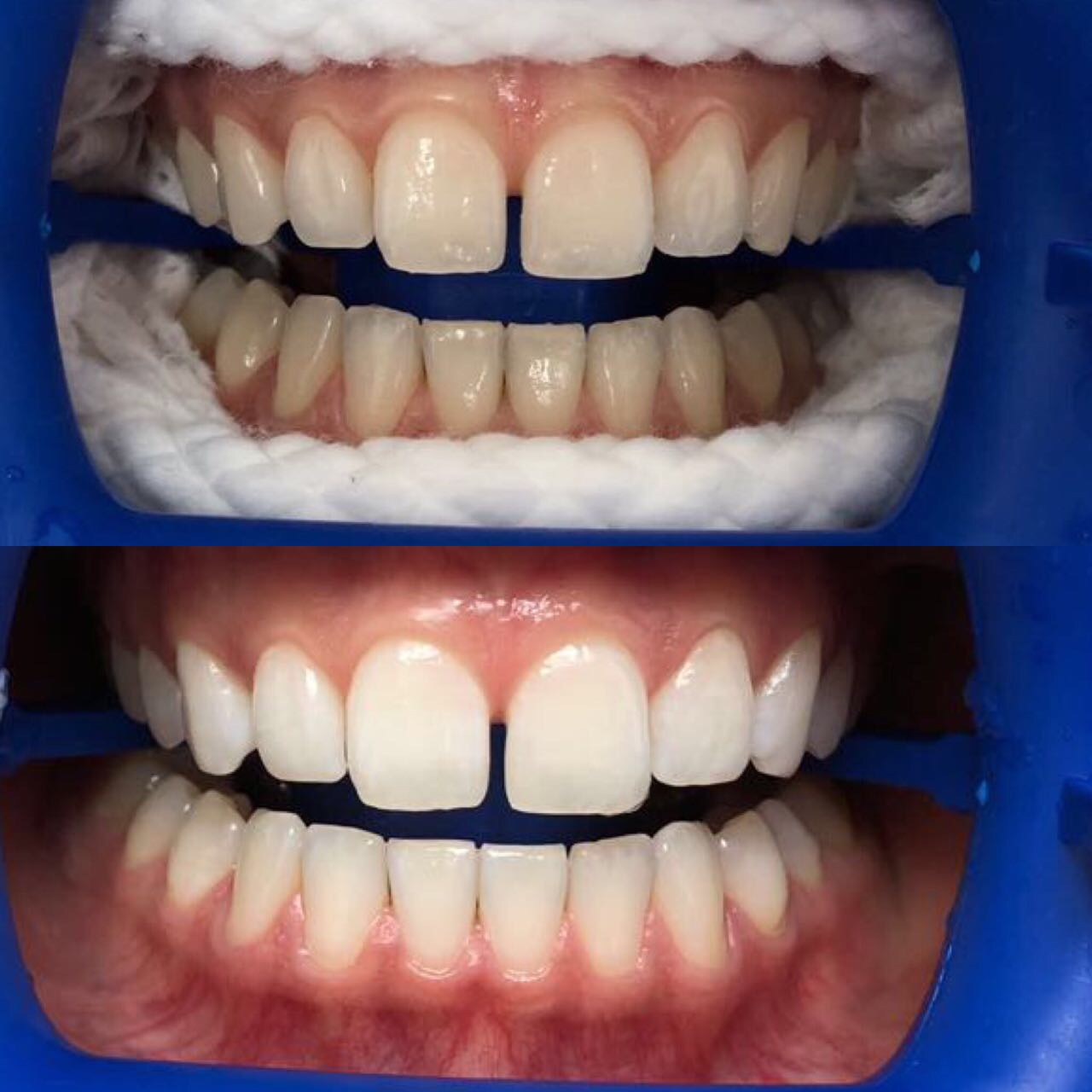 лазерное отбеливание зубов фото до и после
