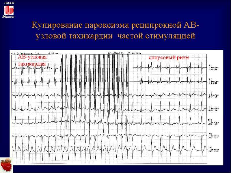 Презентация пароксизмальные тахикардии