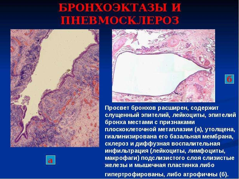 Назовите изменения в стенке бронха при бронхоэктазе