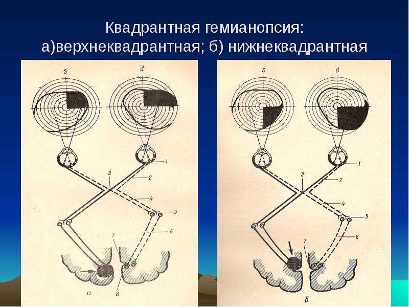 Правосторонняя гемианопсия картинки