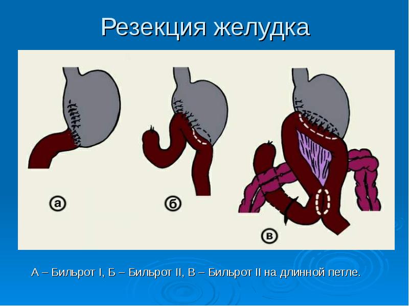 Резекция желудка по витебскому схема операции