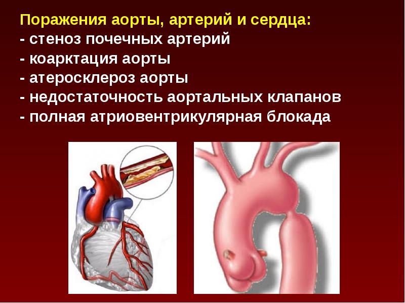 Атеросклероз аорты. Атеросклероз аорты сердца. Атеросклероз корня аорты. Атеросклероз бифуркации аорты.