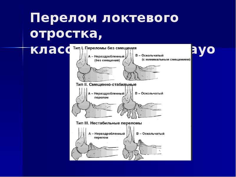 Перелом локтевого отростка