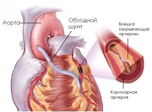 Поставили шунты. Коронарное шунтирование сосудов сердца. Аортокоронарное шунтирование (АКШ). Аорта коронарное шунтирование. Каронанарное шунтирование.
