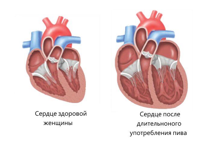 Расширение сердечного сосуда. Сердечно сосудистая система алкоголика. Предсердия кардиомиопатия.