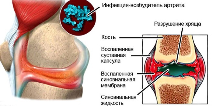 Гнойные заболевания суставов