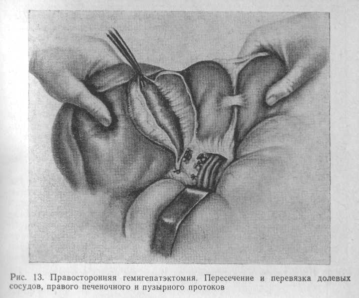 Боль круглой связки. Новокаиновая блокада круглой связки печени. Блокада круглой связки печени техника. Правосторонняя резекция печени. Методика выполнения блокады круглой связки печени.