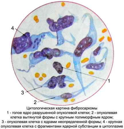 Цитологическая картина фкб - 98 фото