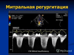 Степень регургитации предсердий. Эхокардиография при митральной недостаточности. Степени митральной недостаточности по ЭХОКГ. Митральная недостаточность на УЗИ сердца. Трикуспидальный клапан степени регургитации по ЭХОКГ.