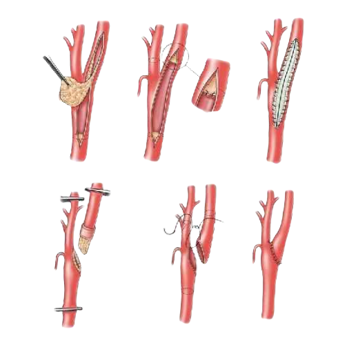 Каротидная эндартерэктомия. Эндартерэктомия сонной артерии. Эверсионная каротидная. Эверсионная эндартерэктомия.