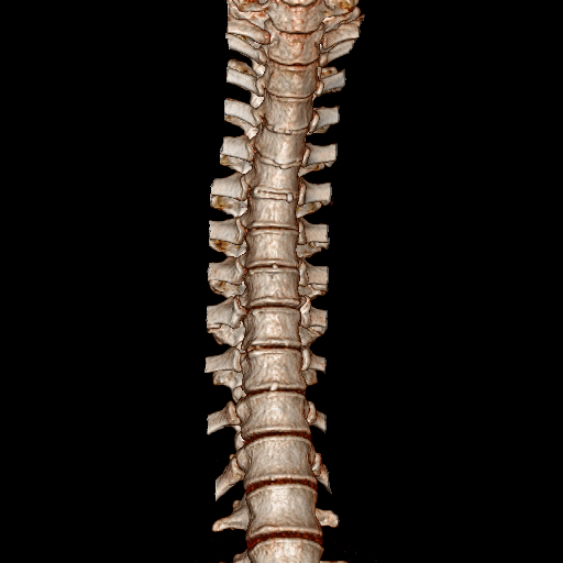 Можно сделать кт позвоночника. Мультисрезовая кт позвоночника. 3 Позвонок.