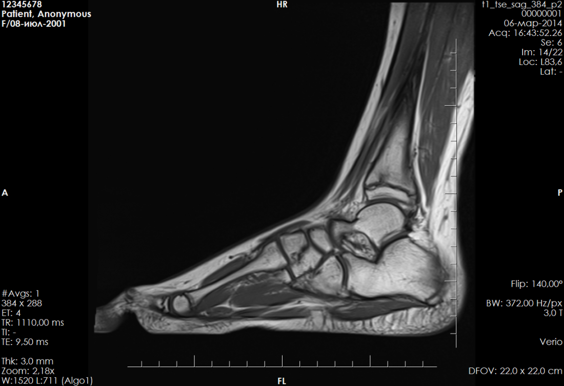 Кт сухожилия. Синовиома голеностопного сустава мрт. Анатомия голеностопного сустава мрт. Мрт разрыв связок голеностопа. Кт анатомия голеностопного сустава.