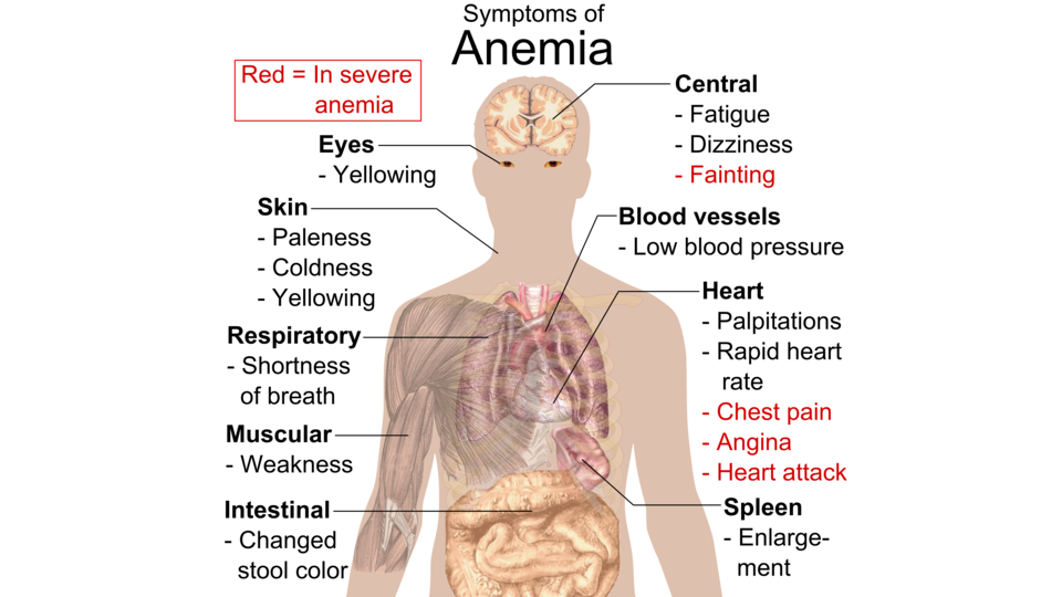 Недостаток железа приводит к заболеванию. Симптомы низкого ферритина. Болезни крови симптомы. Клиническая картина анемии.