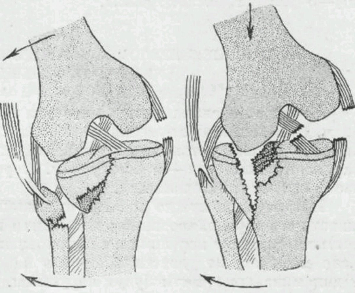 Импрессионный перелом мыщелков. Перелом наружного мыщелка большеберцовой. Перелом наружного мыщелка большеберцовой кости. Внутрисуставной перелом большеберцовой кости коленного сустава. Перелом наружного мыщелка бедренной кости.