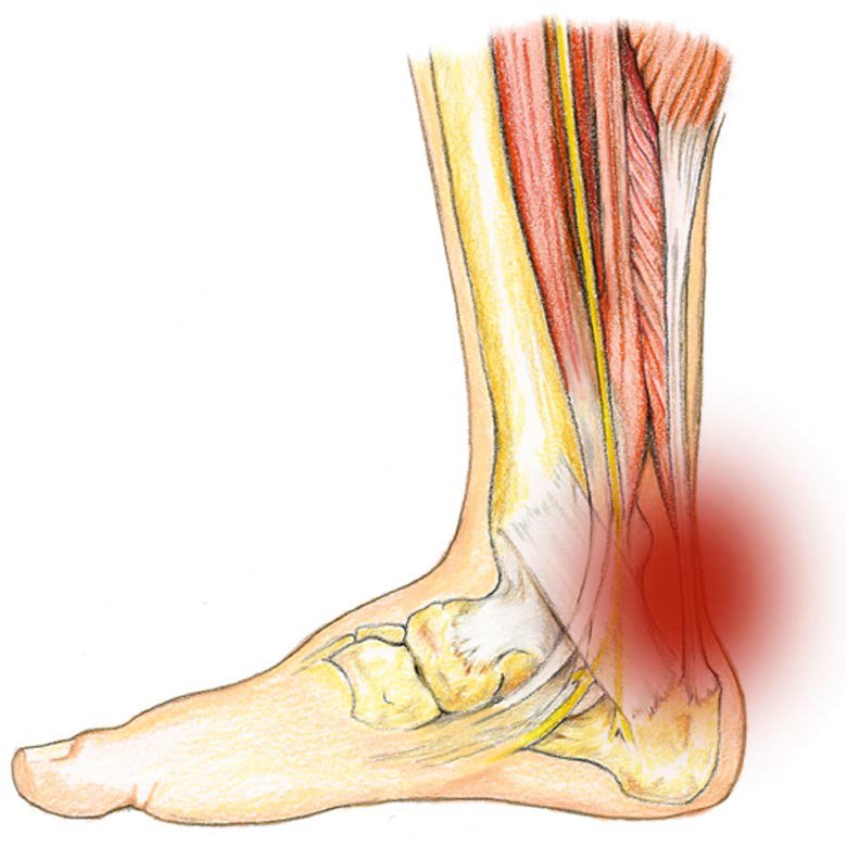 Где находится ахиллово сухожилие на ноге фото у человека как лечить