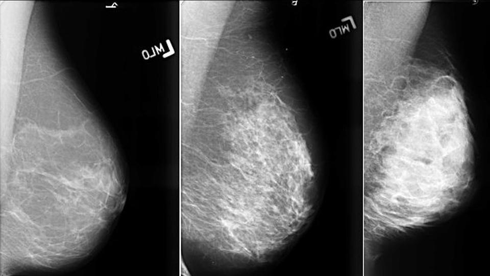 Аденоз на маммографии. Фиброзно-кистозная мастопатия маммография. Фиброзно кистозная мастопатия маммограмма. Фибролипома маммография.